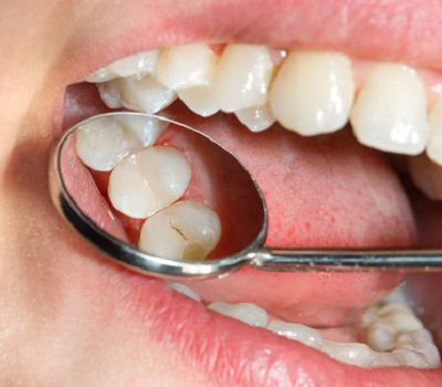 Full Mouth Reconstruction Full Mouth Reconstruction