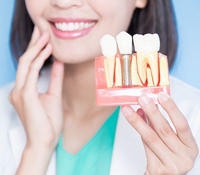 Dental Implants Dental Implants