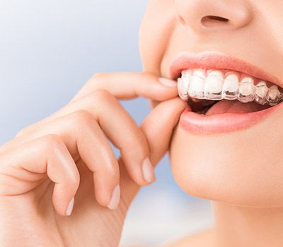 Invisalign Invisalign